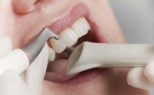 Zahnreinigung mit Pulver-Wasserstrahlgerät